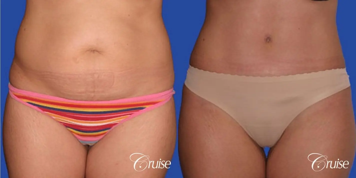 best standard tummy tuck scar on small female patient - Before and After 1