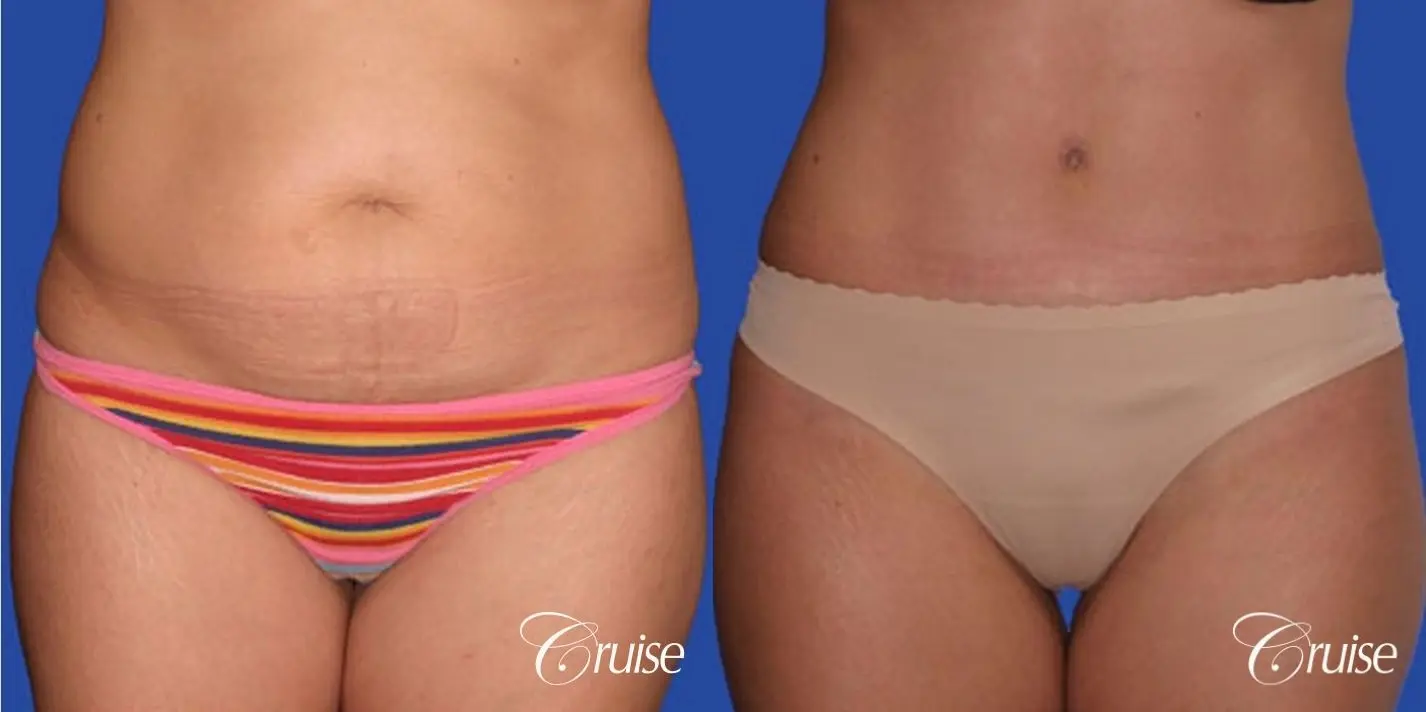 amatuer wife with tummy tuck scar