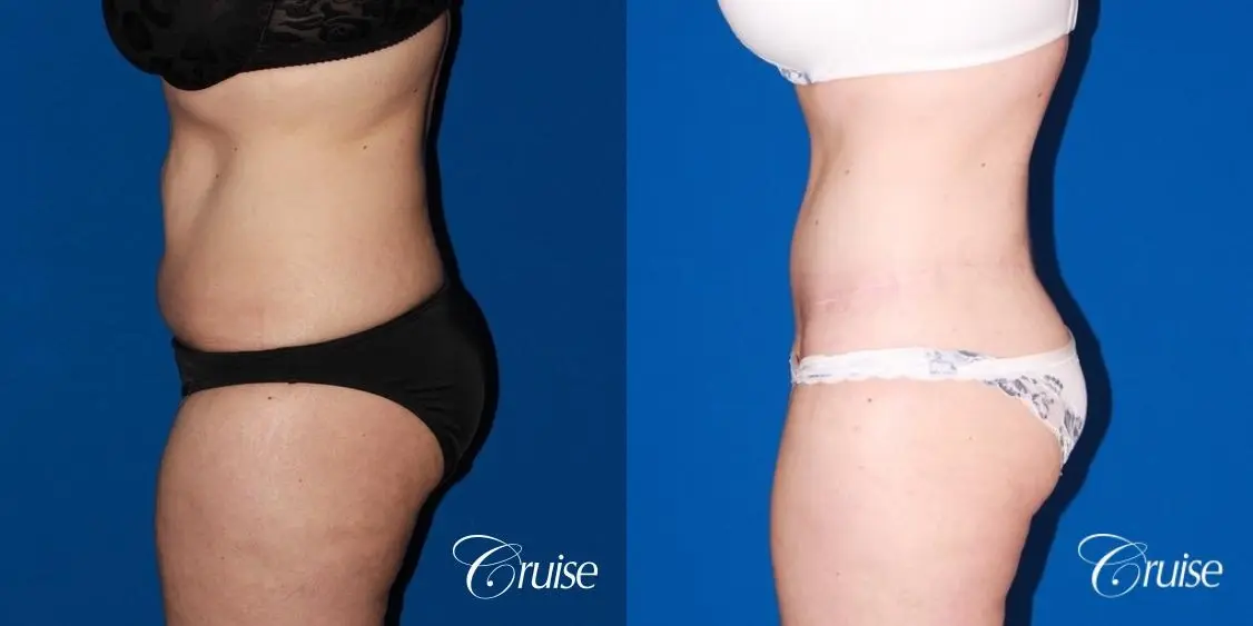 35 Yr Old Female  with Circumferential Tummy Tuck & Liposuction - Before and After 2