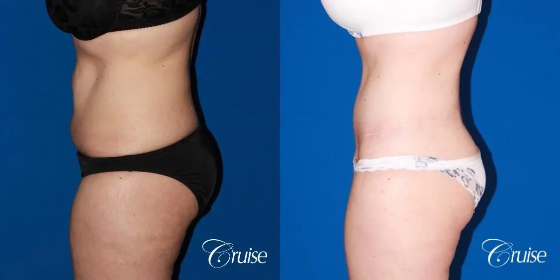 35 Yr Old Female with Circumferential Tummy Tuck & Liposuction - Before and After 2