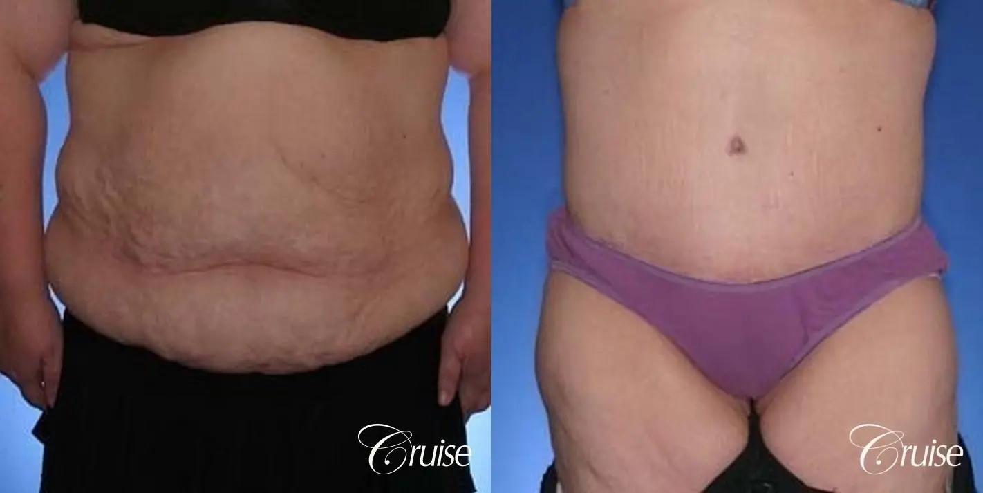 best before and after pictures of extended tummy tuck scar - Before and After 1