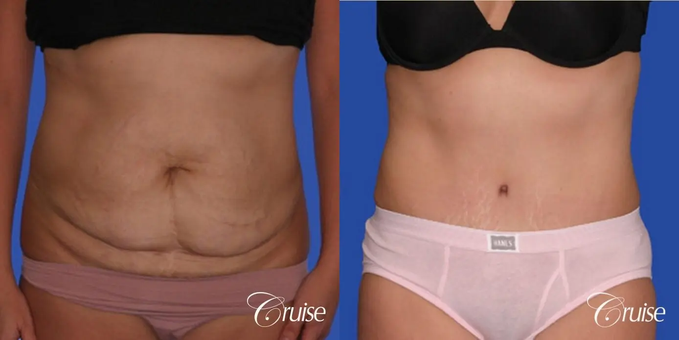 best pics of tummy tuck low scar - Before and After 1