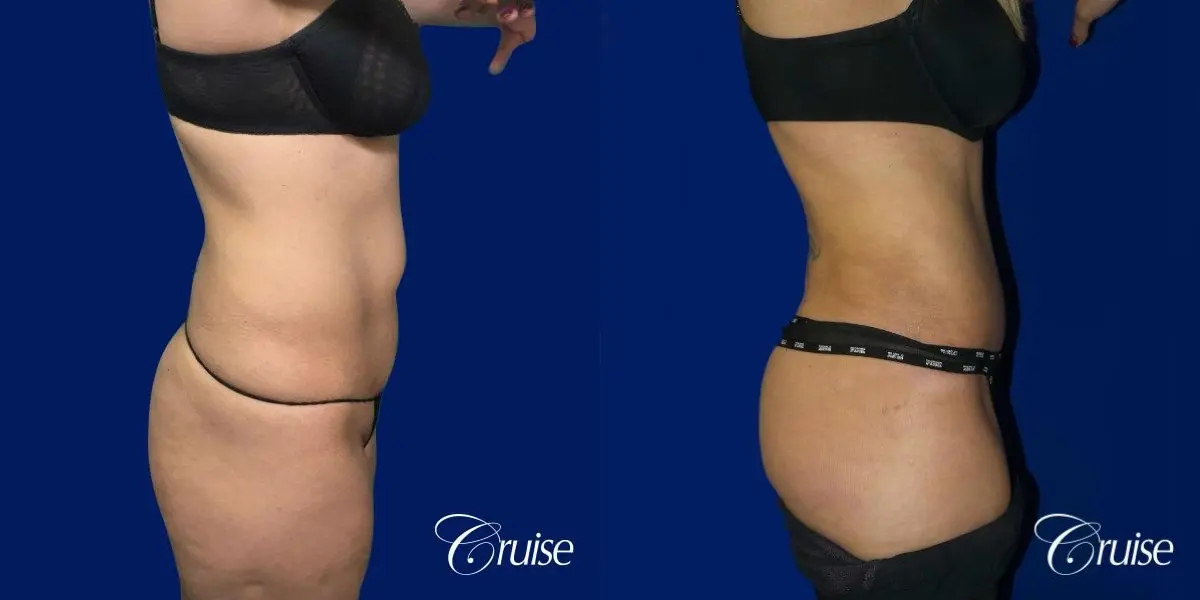 Tummy Tuck Standard Incision - Before and After 4