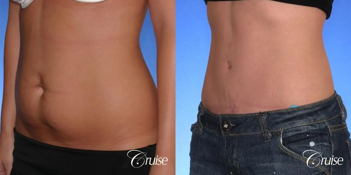 Tummy Tuck: Patient 34 - Before and After 2