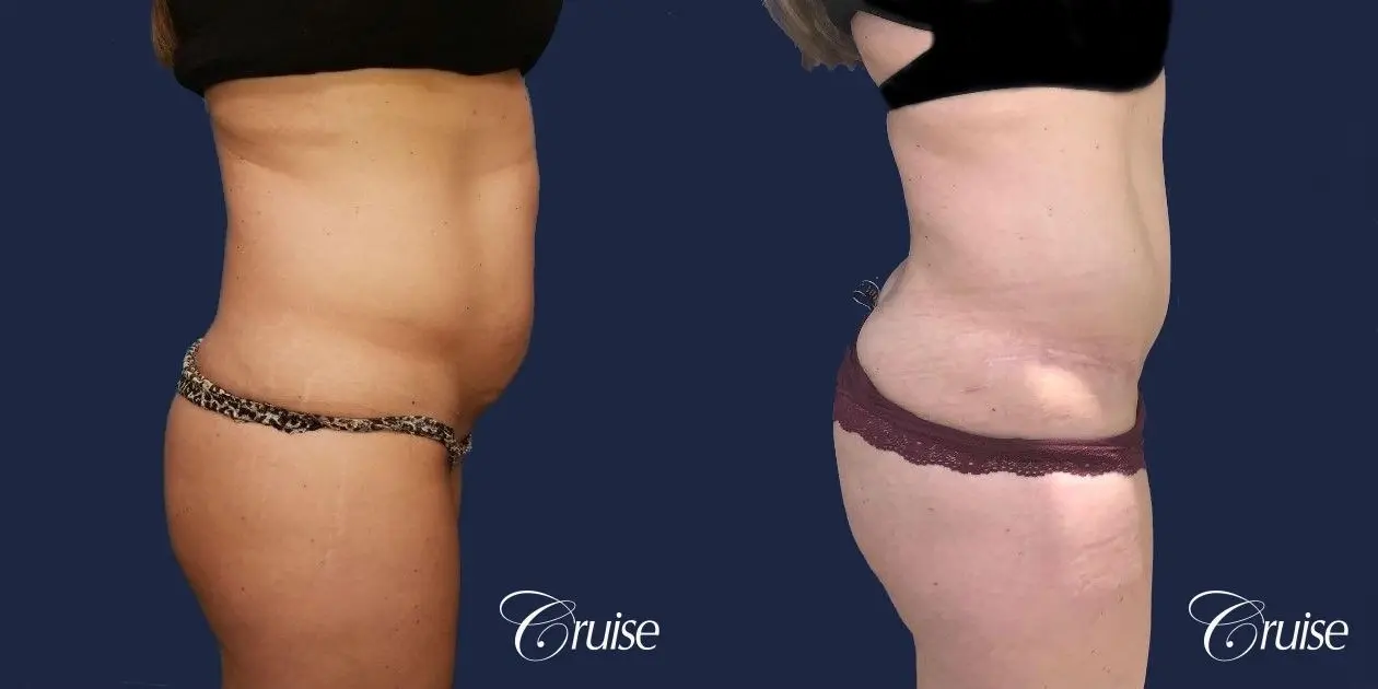 Standard Tummy Tuck - Before and After 2