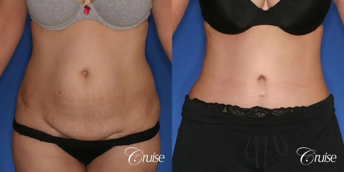 Tummy Tuck - Standard Incision - Before and After 1