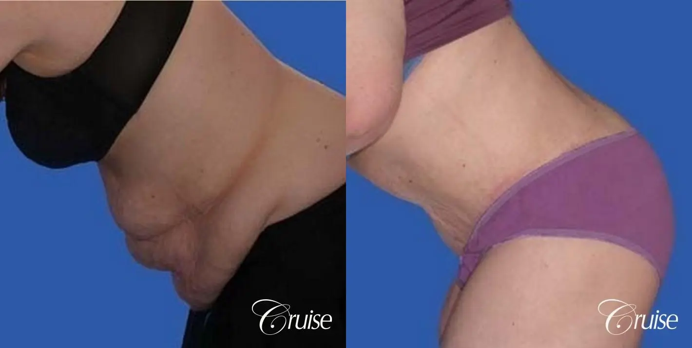 best before and after pictures of extended tummy tuck scar - Before and After 3