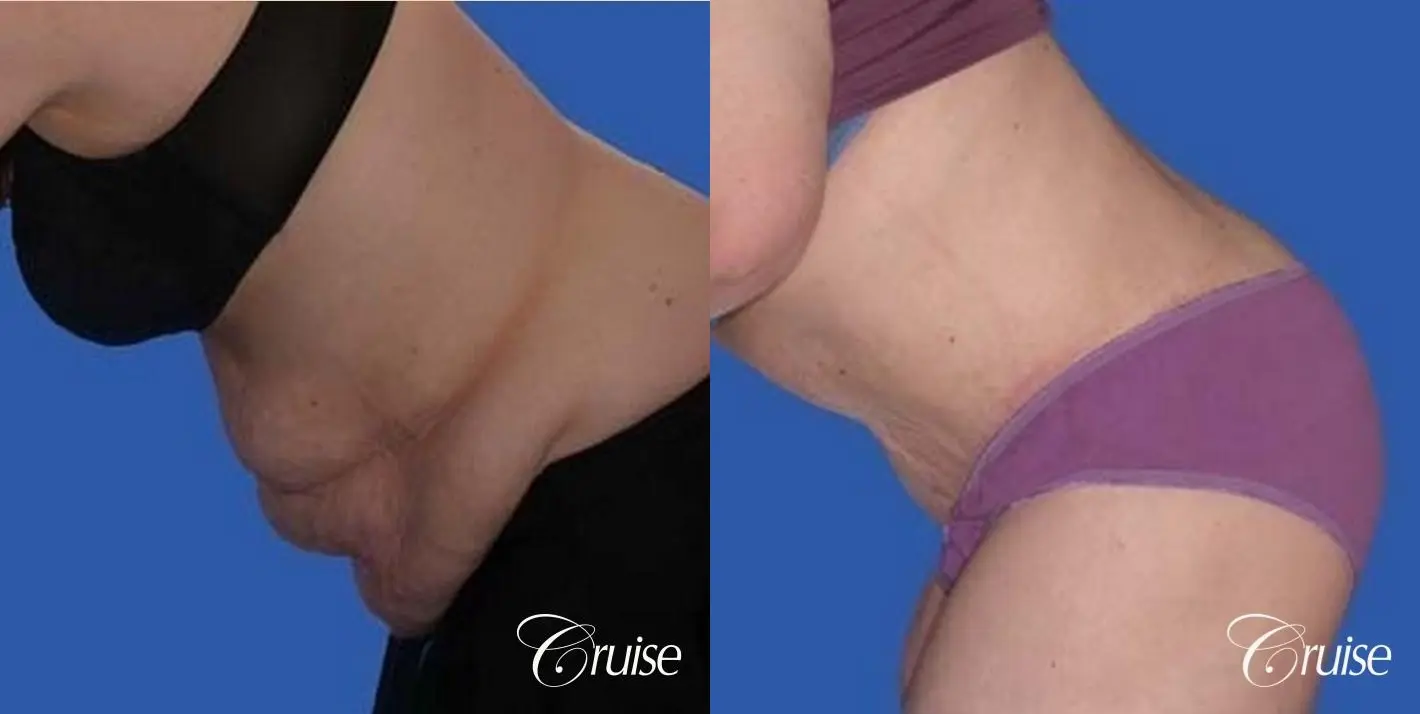 Tummy Tuck Scars Before and After Photo Gallery, Los Angeles, CA