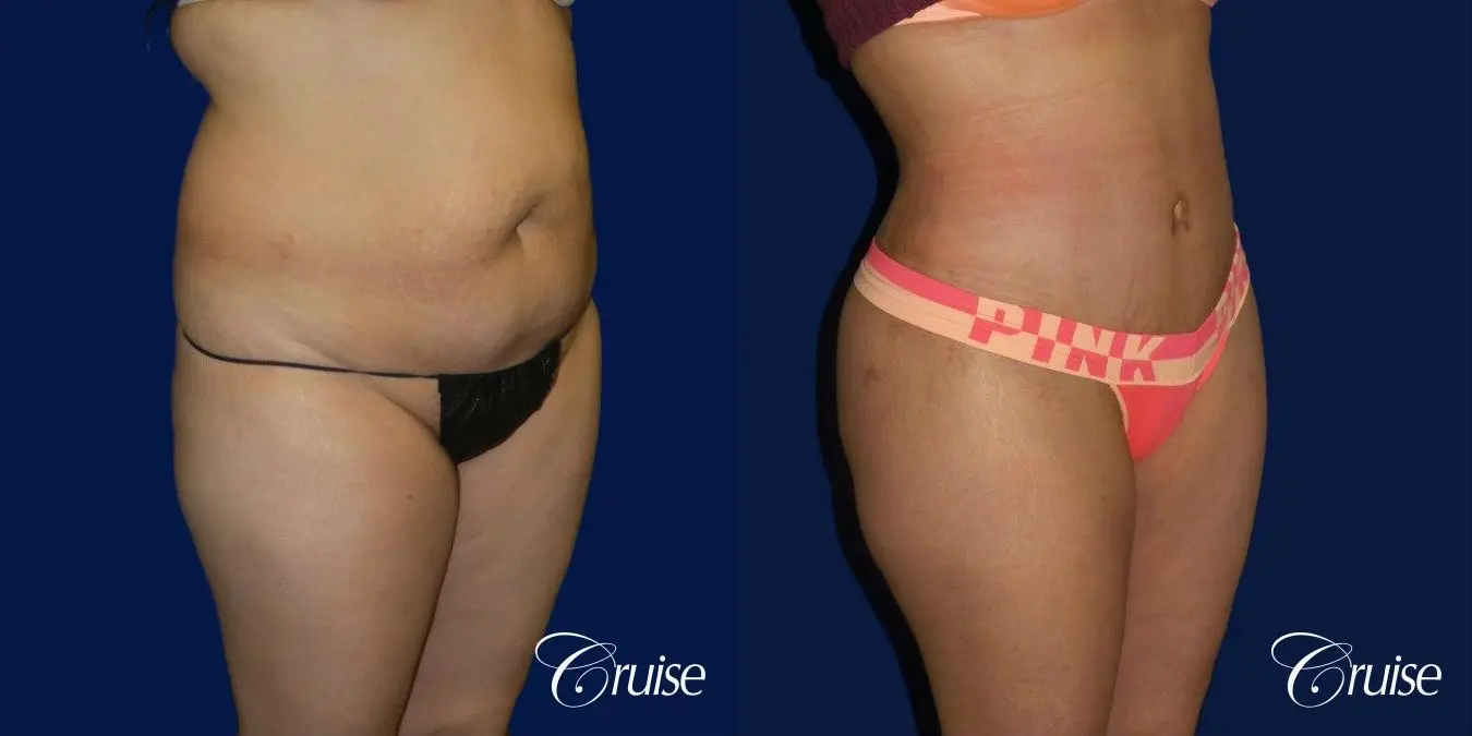 Tummy Tuck Extended Incision - Before and After 2