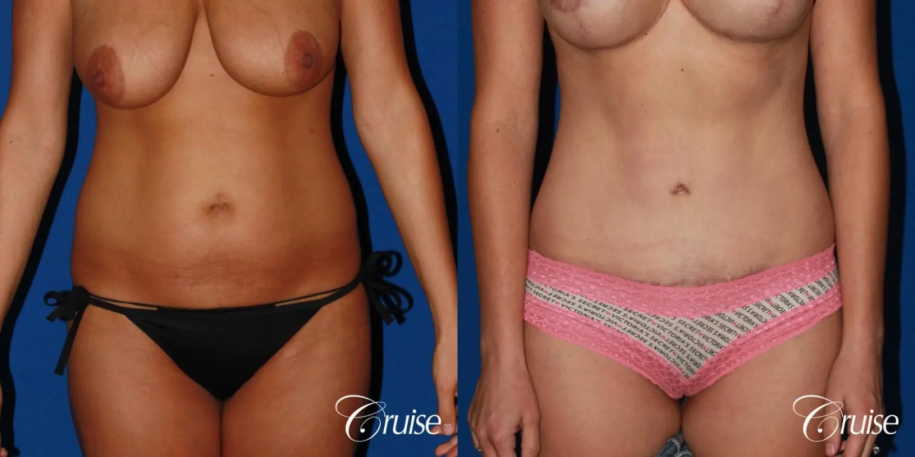 Standard Tummy Tuck & Liposuction: 35 Yr Old Female - Before and After 1
