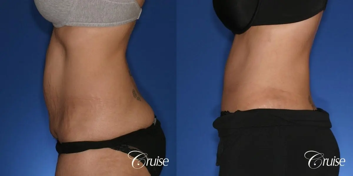 Tummy Tuck - Standard Incision - Before and After 2