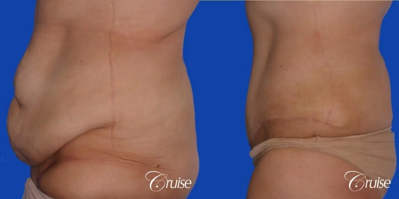 best tummy tuck on weight loss female pictures - Before and After 2