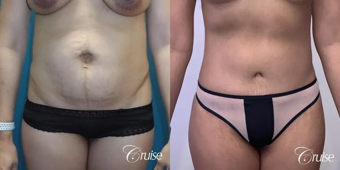 Standard Tummy Tuck, Liposuction with BBL, & Breast Implants: 36 Yr Old Mom - Before and After 1