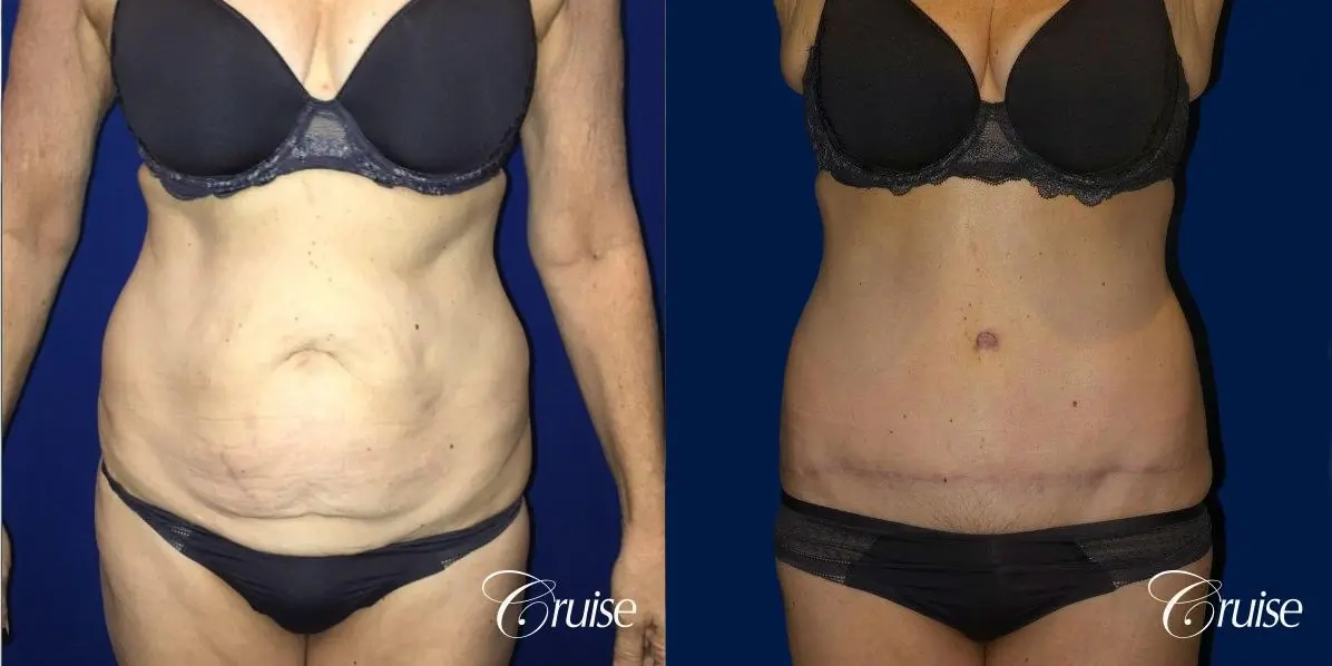 Liposuction & Tummy Tuck Extended Incision  - Before and After 1