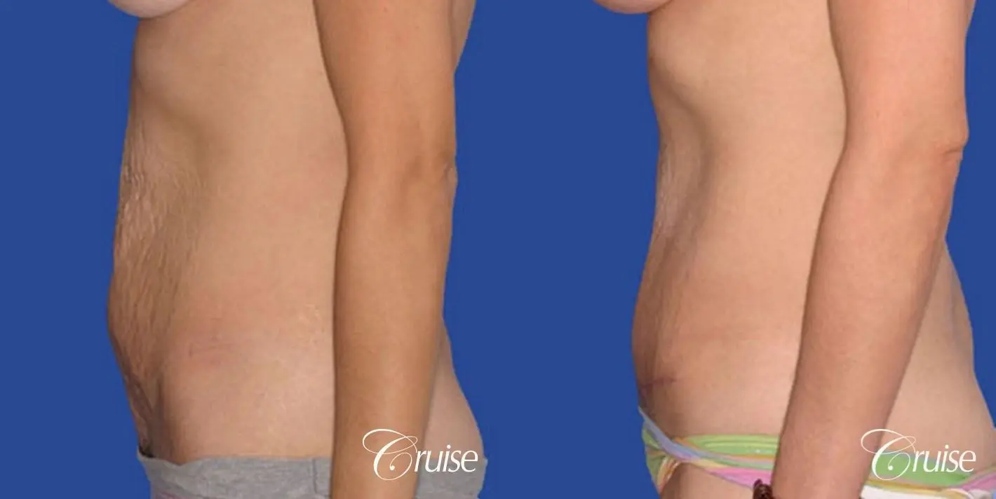 best tummy tuck super low scar plastic surgeon - Before and After 2