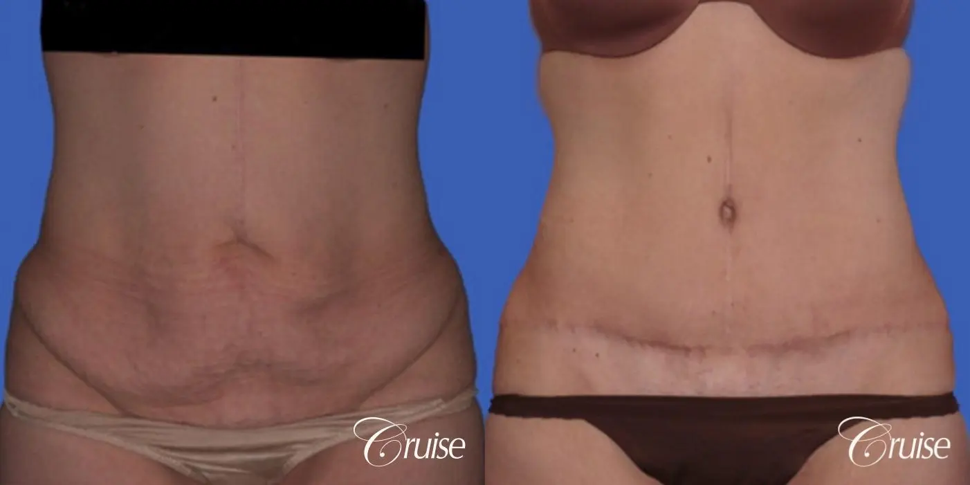 best pictures for standard tummy tuck incision - Before and After 1