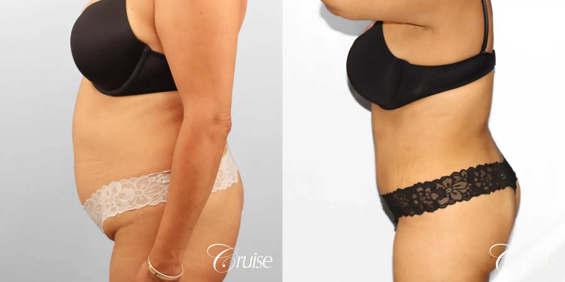 Tummy Tuck: Patient 78 - Before and After 3