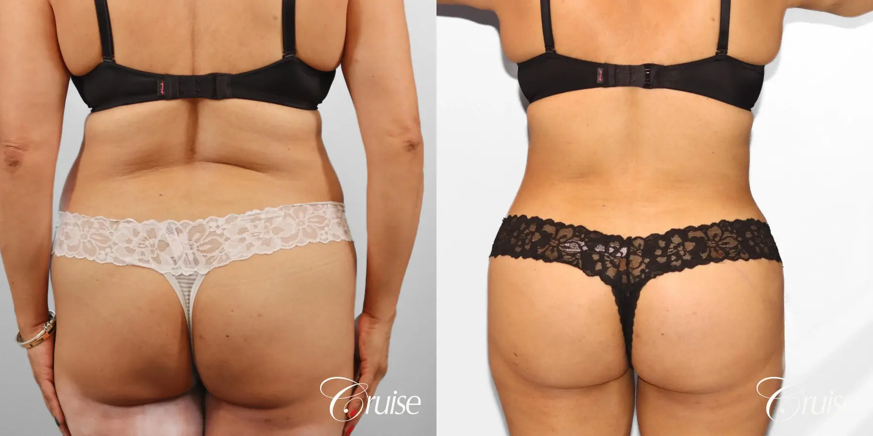 Tummy Tuck: Patient 78 - Before and After 4