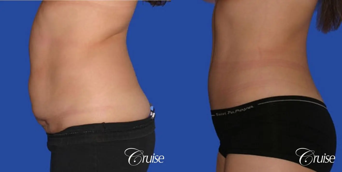 best scar on abdominoplasty tummy tuck - Before and After 2