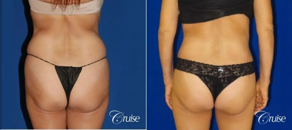 Tummy Tuck Extended Incision - Before and After 3