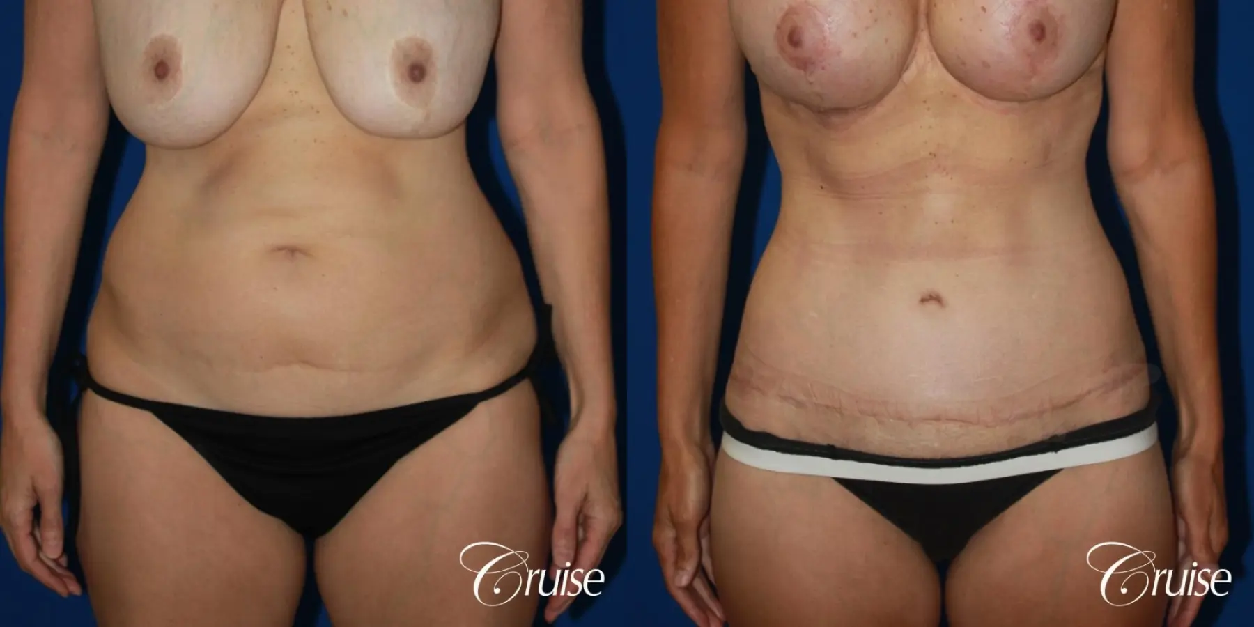 47 Yr Old Liposuction & Circumferential Incision Tummy Tuck - Before and After 1