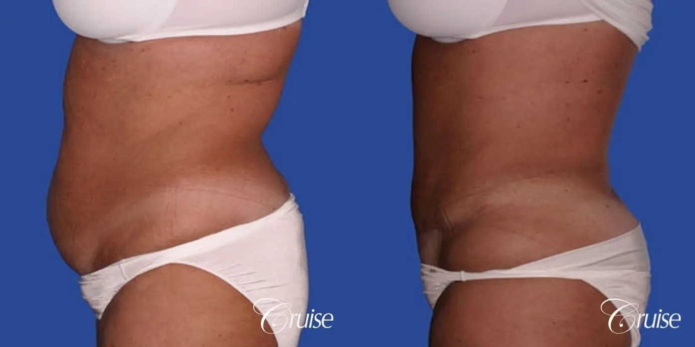 best tummy tuck with liposuction flanks at 50 years old - Before and After 2