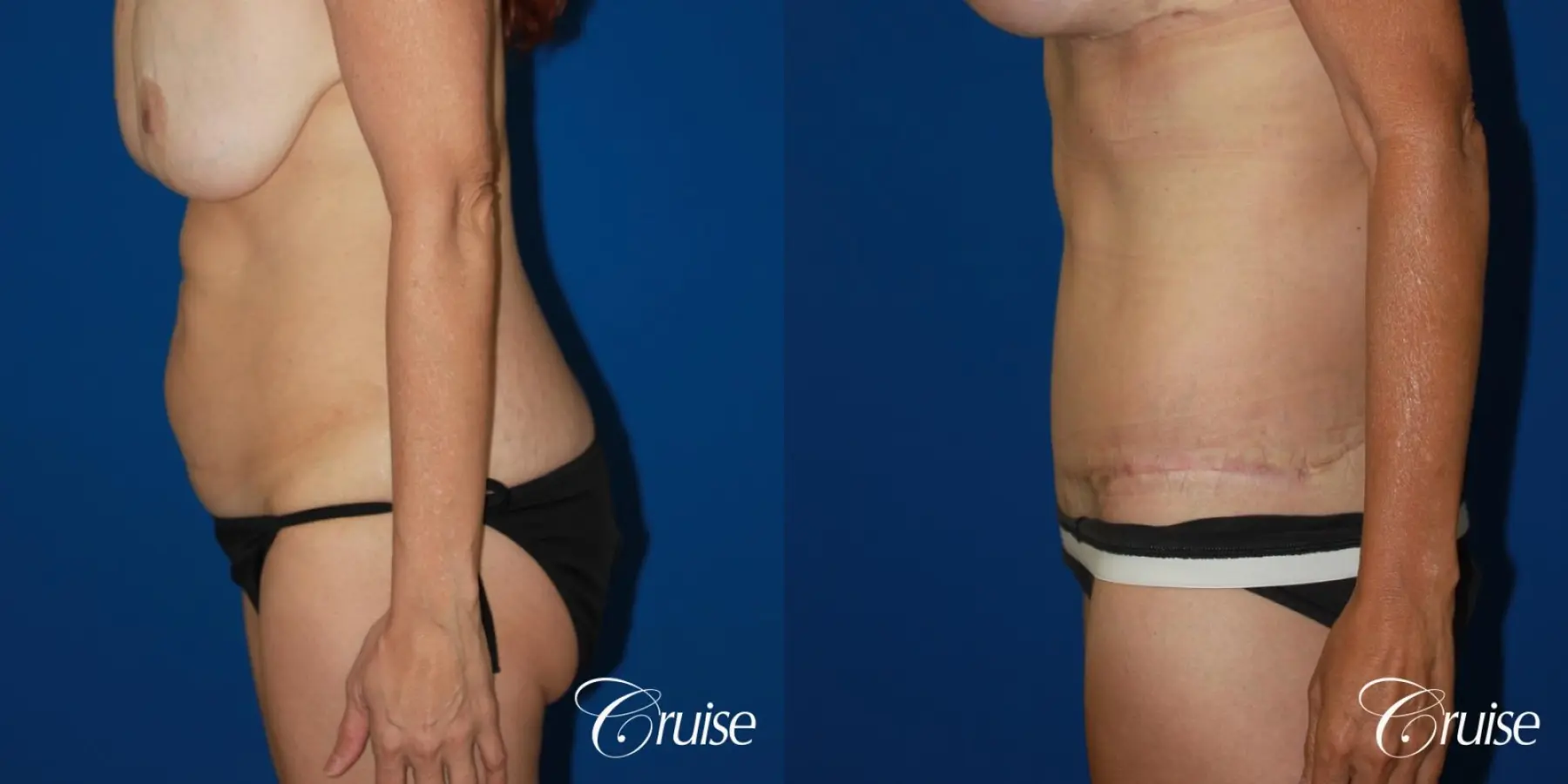 47 Yr Old Liposuction & Circumferential Incision Tummy Tuck - Before and After 2