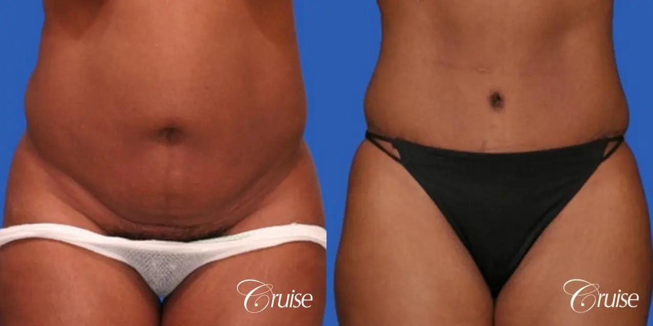 best scar below bikini line on Tummy tuck - Before and After 1