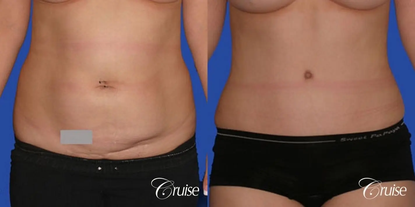best scar on abdominoplasty tummy tuck - Before and After 1