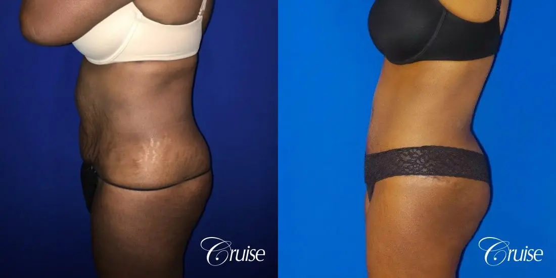 Best Tummy Tucks Orange County CA - Before and After 3