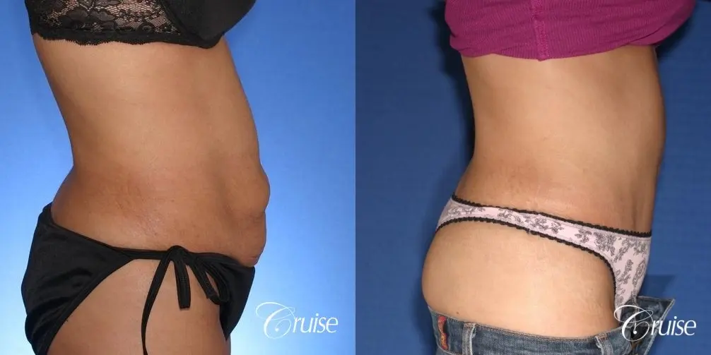 Tummy Tuck: Patient 59 - Before and After 4