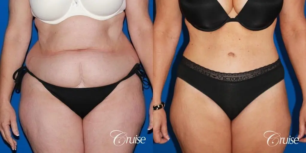 Tummy Tuck: Patient 28 - Before and After 1