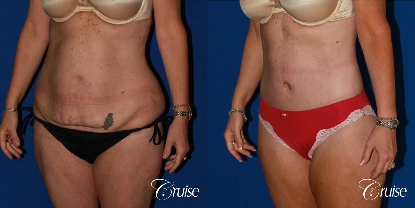 best circumferential body lift tummy tuck scar - Before and After 3