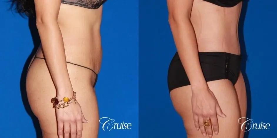 Tummy Tuck & Liposuction: 41 Yr Old Female  - Before and After 4