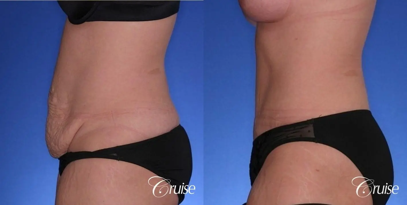 best standard tummy tuck for excess skin - Before and After 2