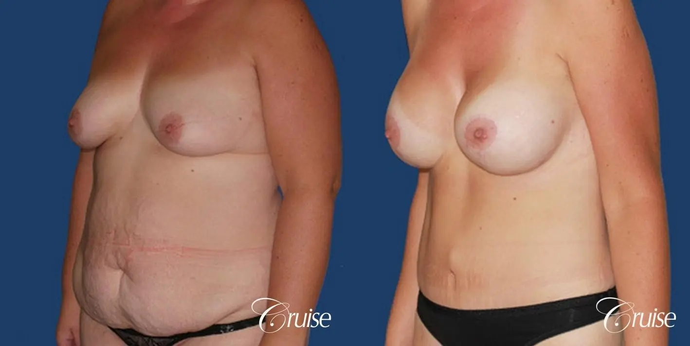 best before and after tummy tuck - Before and After 3