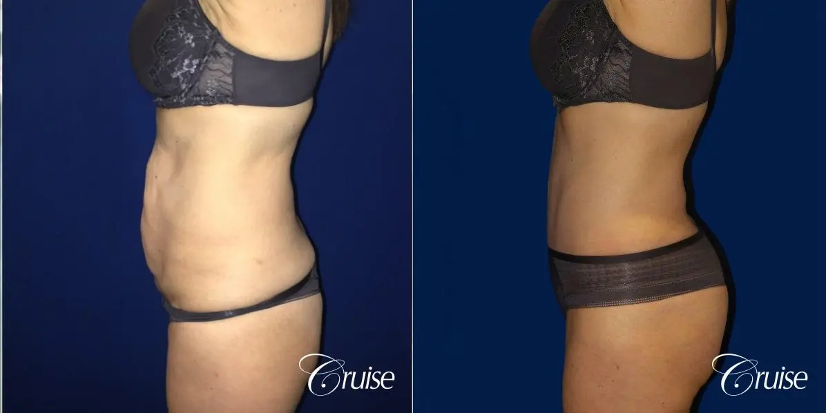 Liposuction & Tummy Tuck Extended Incision  - Before and After 2
