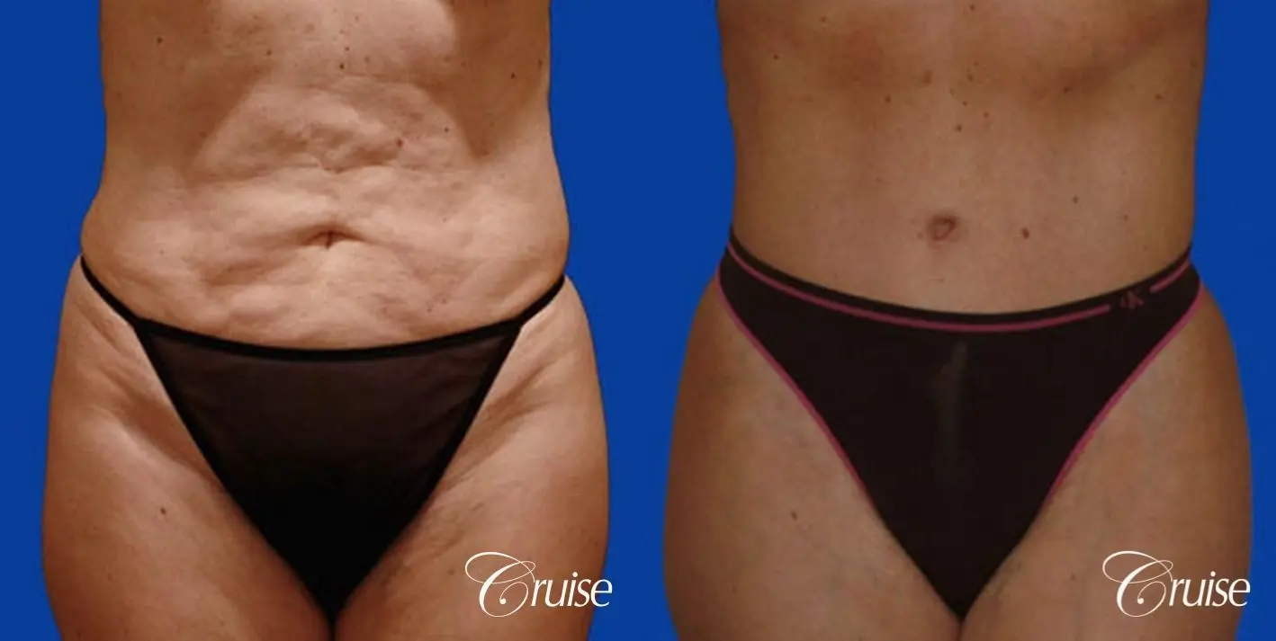 best tummy tuck with top plastic surgeon in Newport Beach - Before and After 1