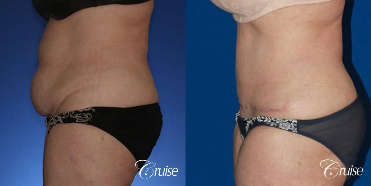 female photos of tummy tuck results - Before and After 2