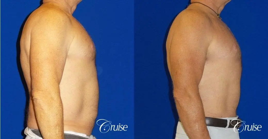 Standard Tummy Tuck & Liposuction: 54 Yr Old Male - Before and After 2