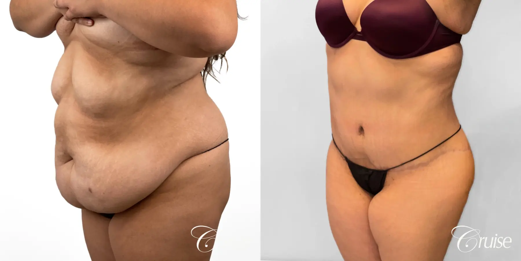 Tummy Tuck: Patient 79 - Before and After 2