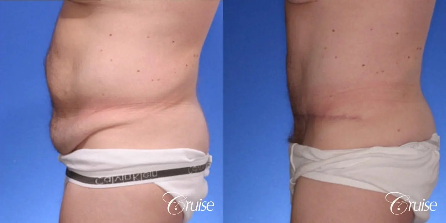 best male with abdominoplasty tummy tuck extended scar - Before and After 2
