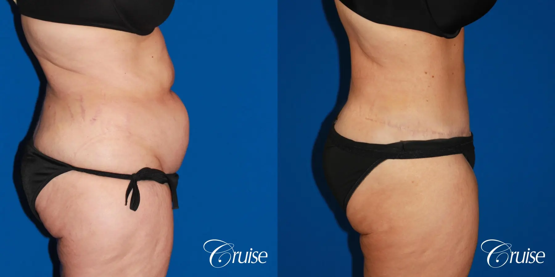 Tummy Tuck: Patient 80 - Before and After 3