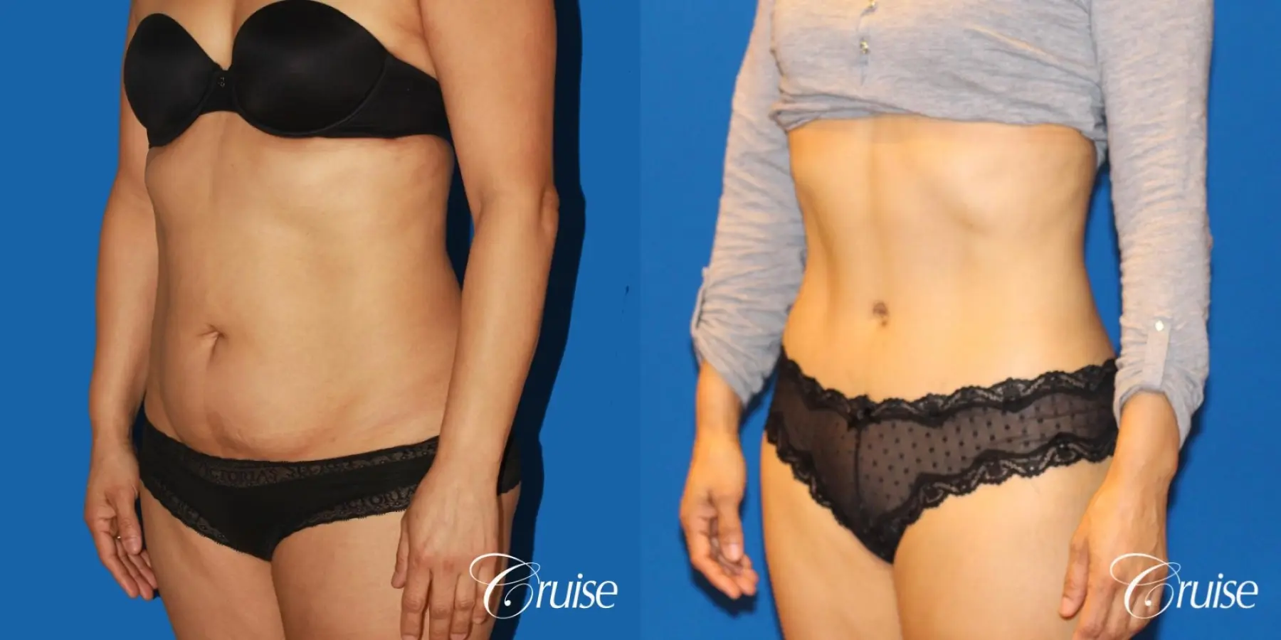 Tummy Tuck: Patient 21 - Before and After 3