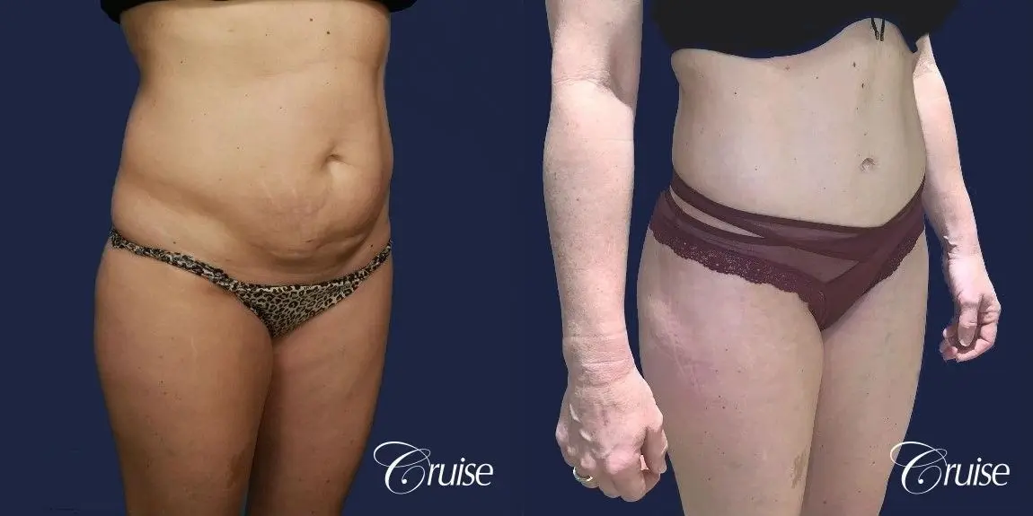 Standard Tummy Tuck - Before and After 3