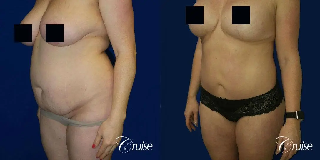 Best tummy tucks dr cruise - Before and After 3