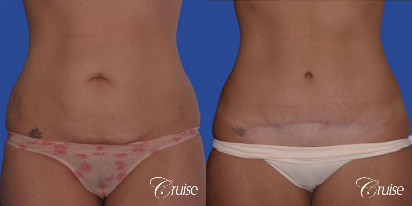 best pictures of abdominoplasty tummy tuck with low scar - Before and After 1