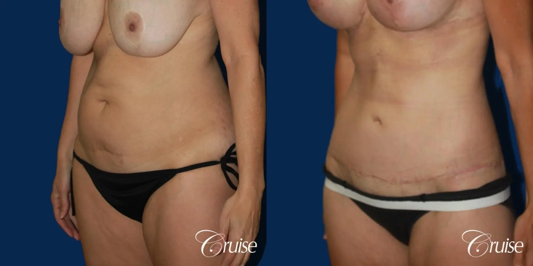 47 Yr Old Liposuction & Circumferential Incision Tummy Tuck - Before and After 3