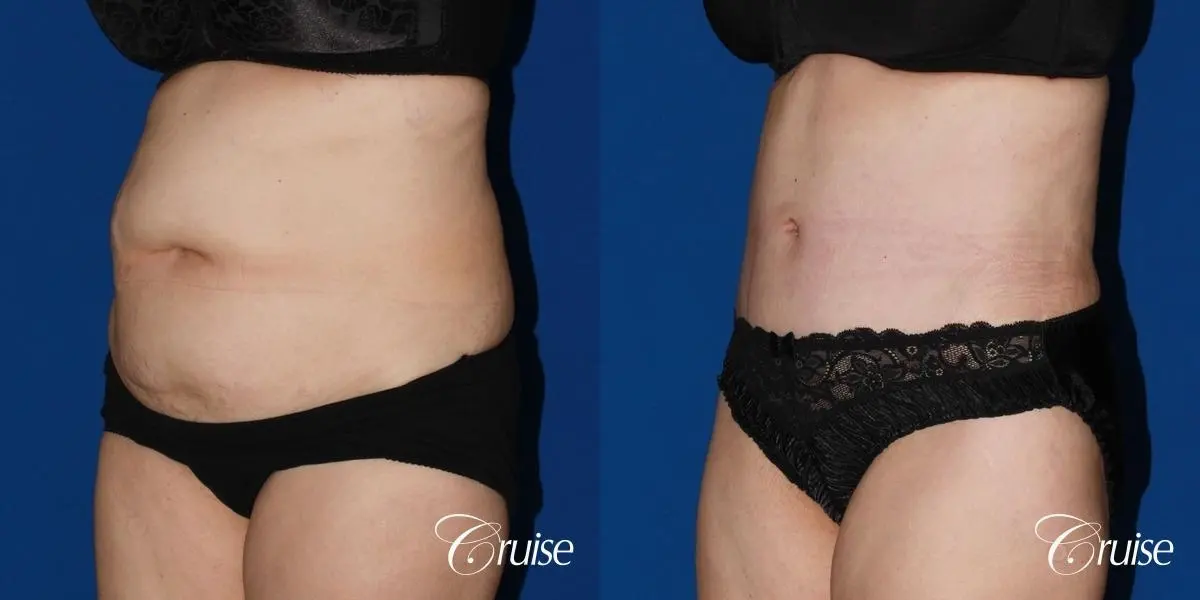 Tummy Tuck: Patient 28 - Before and After 3