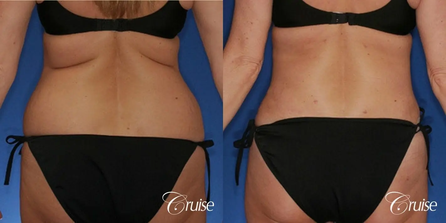 best tummy tuck with liposuction flanks - Before and After 4